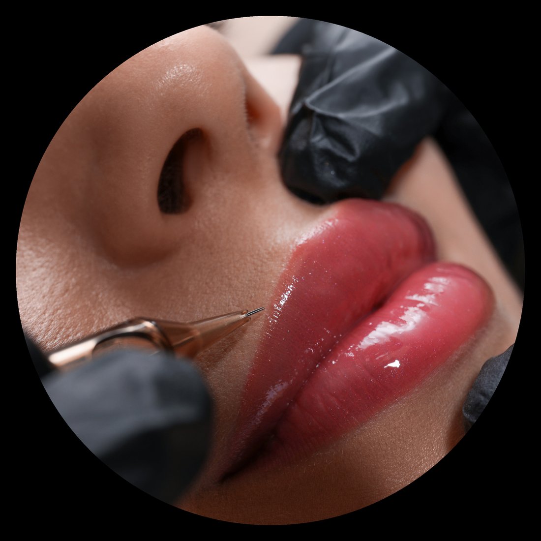 Hyaluron Lippenaufbau mit dem IRI Pen in Dörpen – Behandlung ohne Nadel