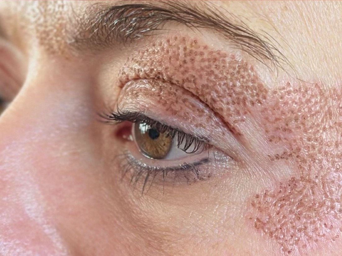 Augenpartie direkt nach dem Skin Corrector Lifting – feine Pünktchen im behandelten Bereich