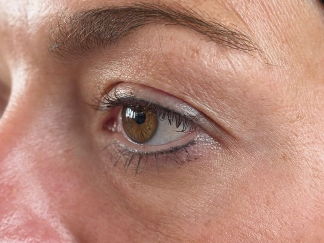 Augenpartie vor dem Skin Corrector Lifting in Dörpen